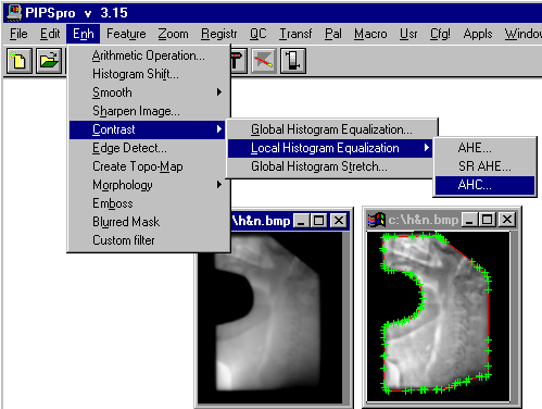 Contrast enhancement of a portal image by adaptive histogram clip