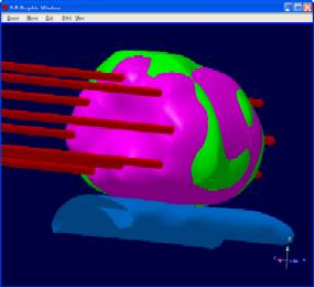 Results of auto dwell calculation show good coverage of target volume