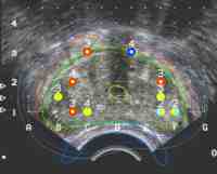 Exact dosimetry even with different seed types