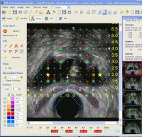 PSID - Brachytherapy Planning Screen Shot
