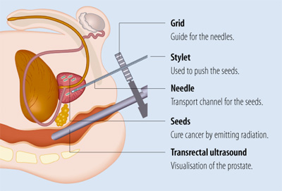 prostate treatment with seeds