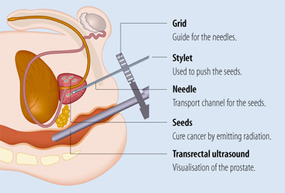 prostate cancer treatment brachytherapy