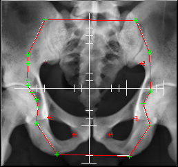 DRR reference image with field edge and fiducial points